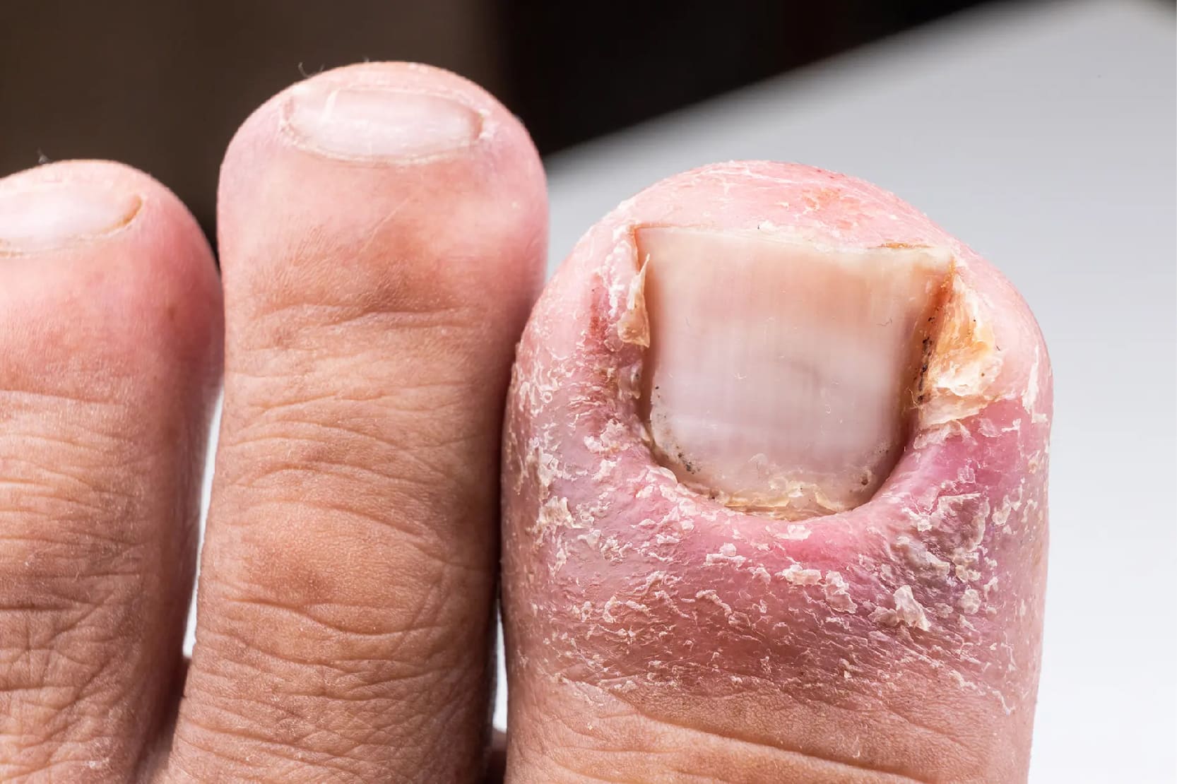 Nail Infections